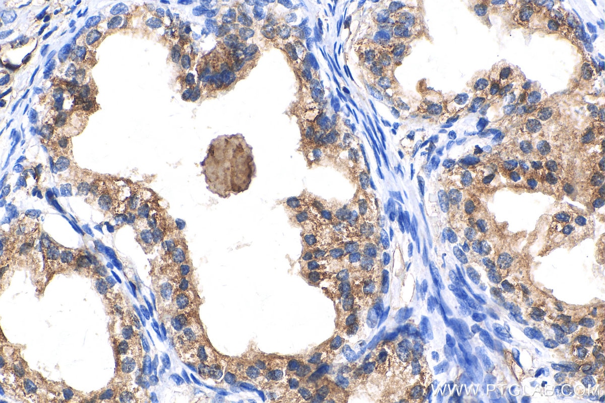 Immunohistochemistry (IHC) staining of human prostate cancer tissue using Beta-2-Microglobulin Polyclonal antibody (13511-1-AP)