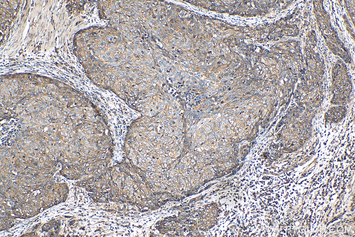 Immunohistochemistry (IHC) staining of human oesophagus cancer tissue using Beta-2-Microglobulin Polyclonal antibody (13511-1-AP)