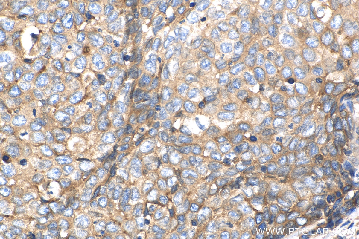 Immunohistochemistry (IHC) staining of human oesophagus cancer tissue using Beta-2-Microglobulin Polyclonal antibody (13511-1-AP)