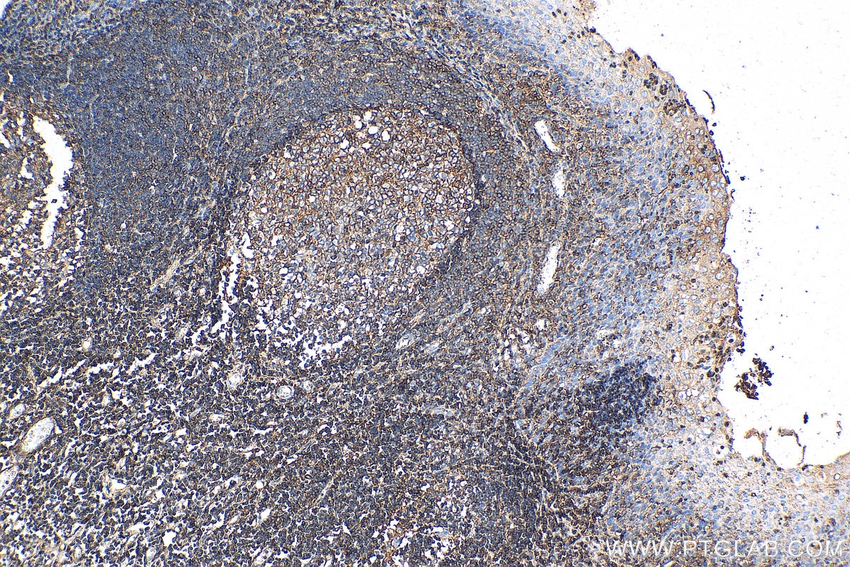 IHC staining of human tonsillitis using 13511-1-AP