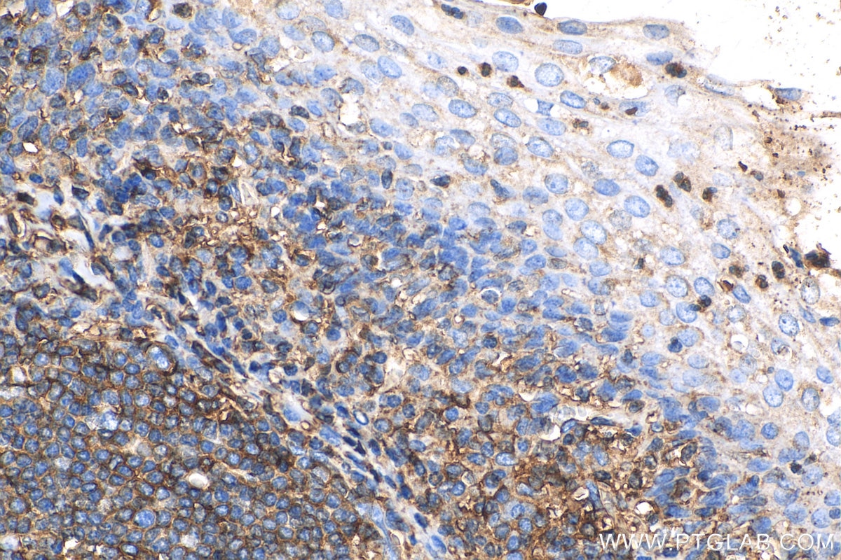 Immunohistochemistry (IHC) staining of human tonsillitis tissue using Beta-2-Microglobulin Polyclonal antibody (13511-1-AP)