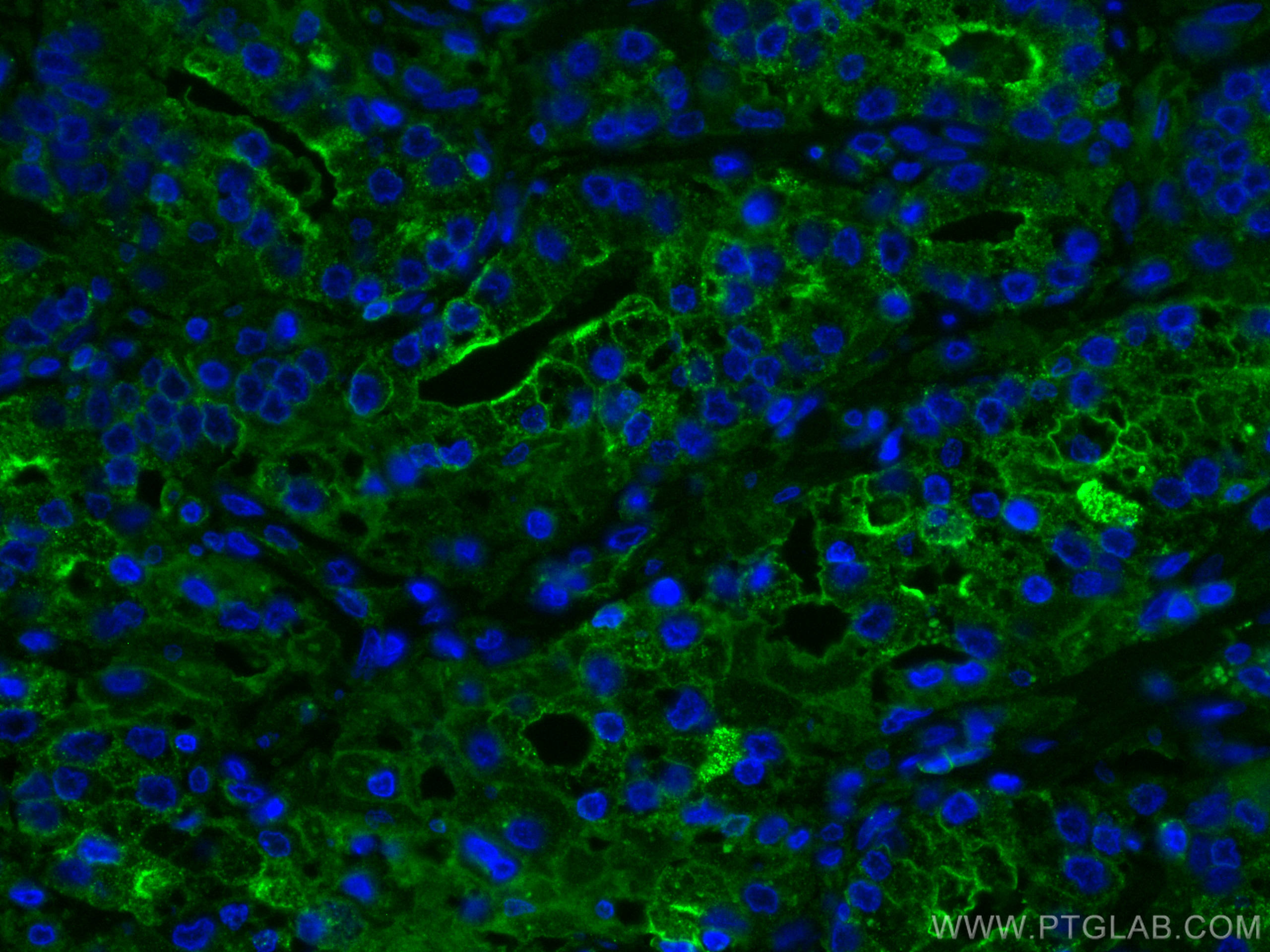 Immunofluorescence (IF) / fluorescent staining of human prostate cancer tissue using Beta-2-Microglobulin Monoclonal antibody (66207-1-Ig)