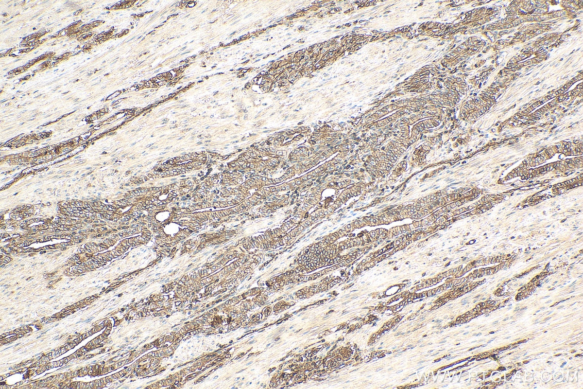 Immunohistochemistry (IHC) staining of human prostate cancer tissue using Beta-2-Microglobulin Monoclonal antibody (66207-1-Ig)