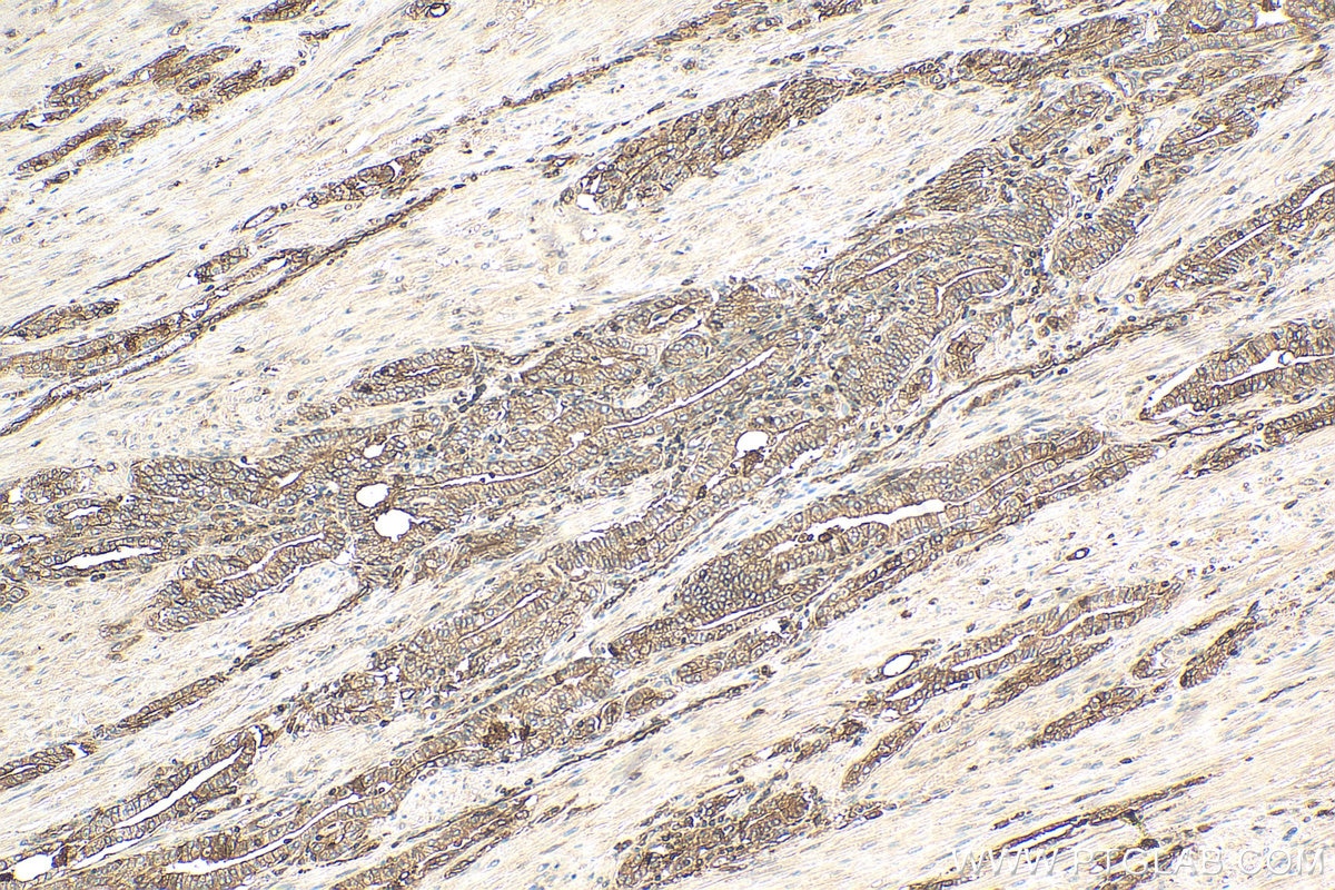 IHC staining of human prostate cancer using 66207-1-Ig