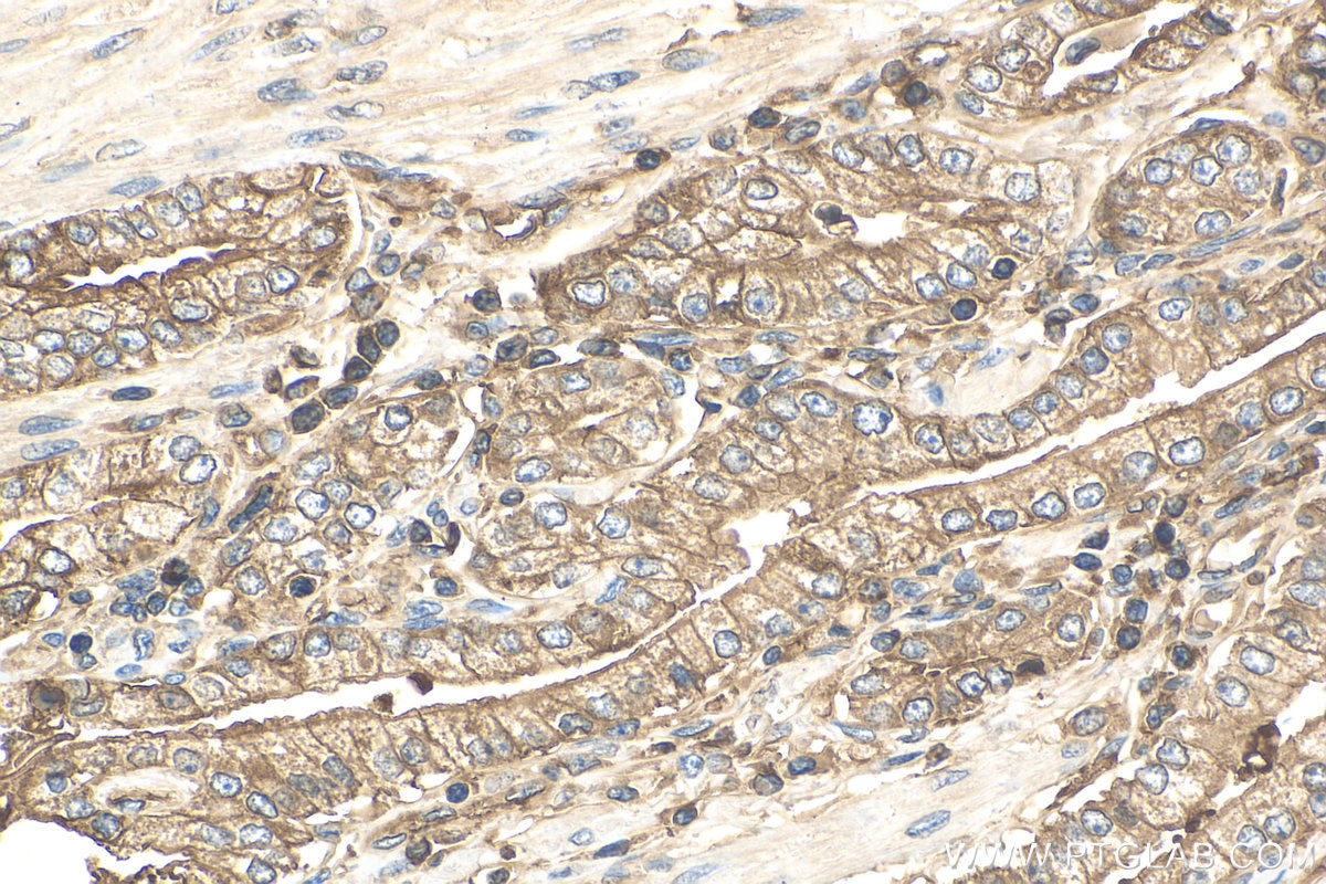 Immunohistochemistry (IHC) staining of human prostate cancer tissue using Beta-2-Microglobulin Monoclonal antibody (66207-1-Ig)