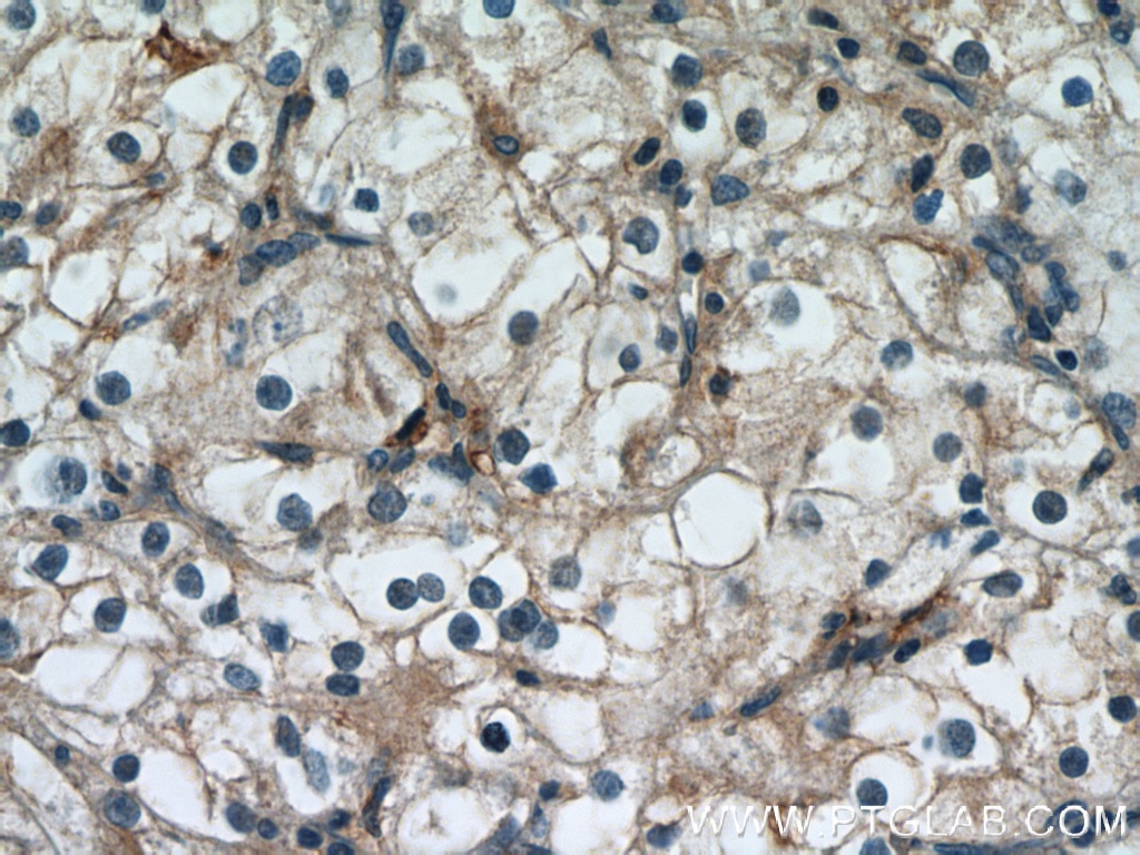 Immunohistochemistry (IHC) staining of human renal cell carcinoma tissue using Beta-2-Microglobulin Monoclonal antibody (66207-1-Ig)