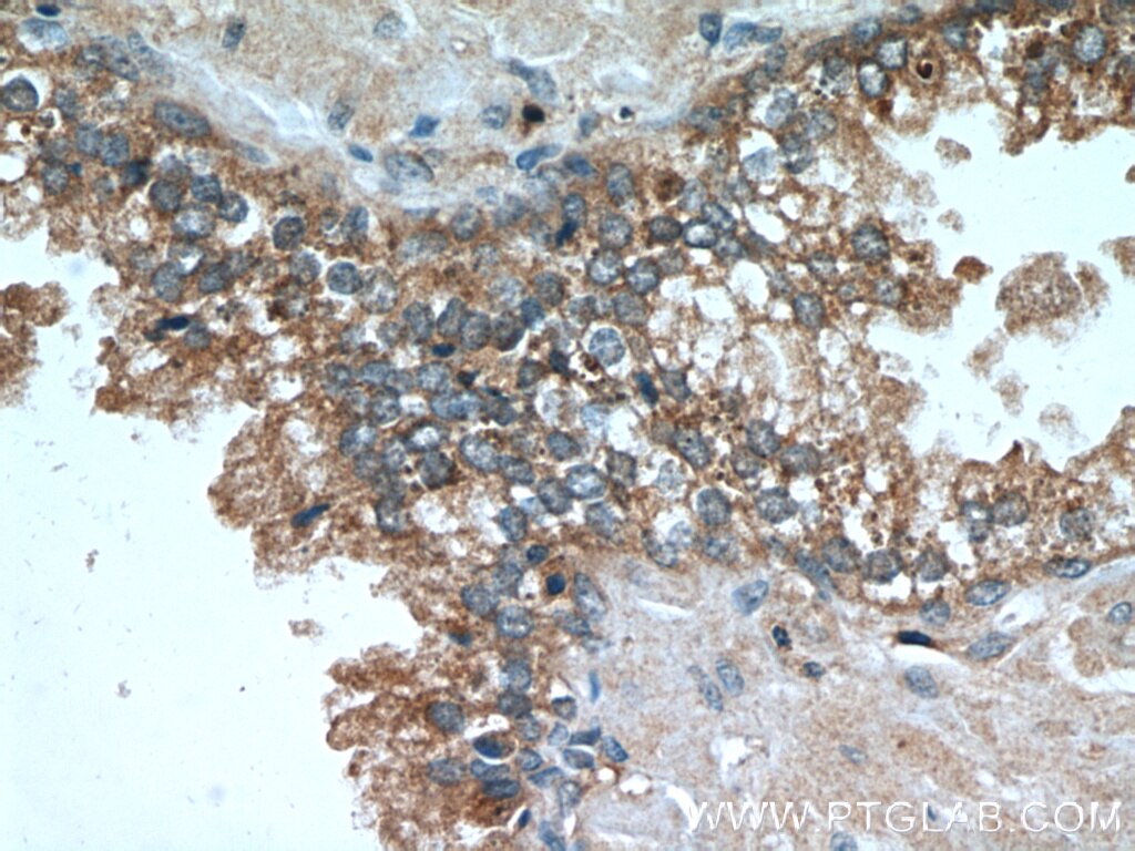 Immunohistochemistry (IHC) staining of human prostate cancer tissue using Beta-2-Microglobulin Monoclonal antibody (66207-1-Ig)
