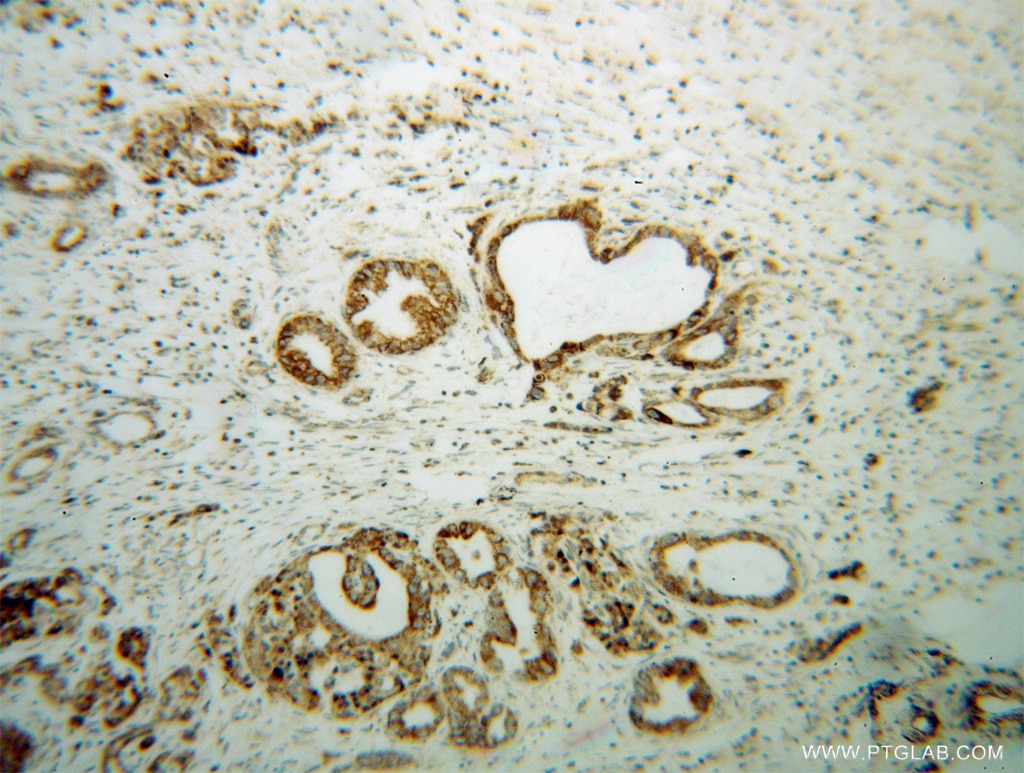 Immunohistochemistry (IHC) staining of human pancreas cancer tissue using B3GALT4 Polyclonal antibody (13490-1-AP)