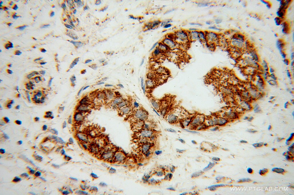 Immunohistochemistry (IHC) staining of human pancreas cancer tissue using B3GALT4 Polyclonal antibody (13490-1-AP)