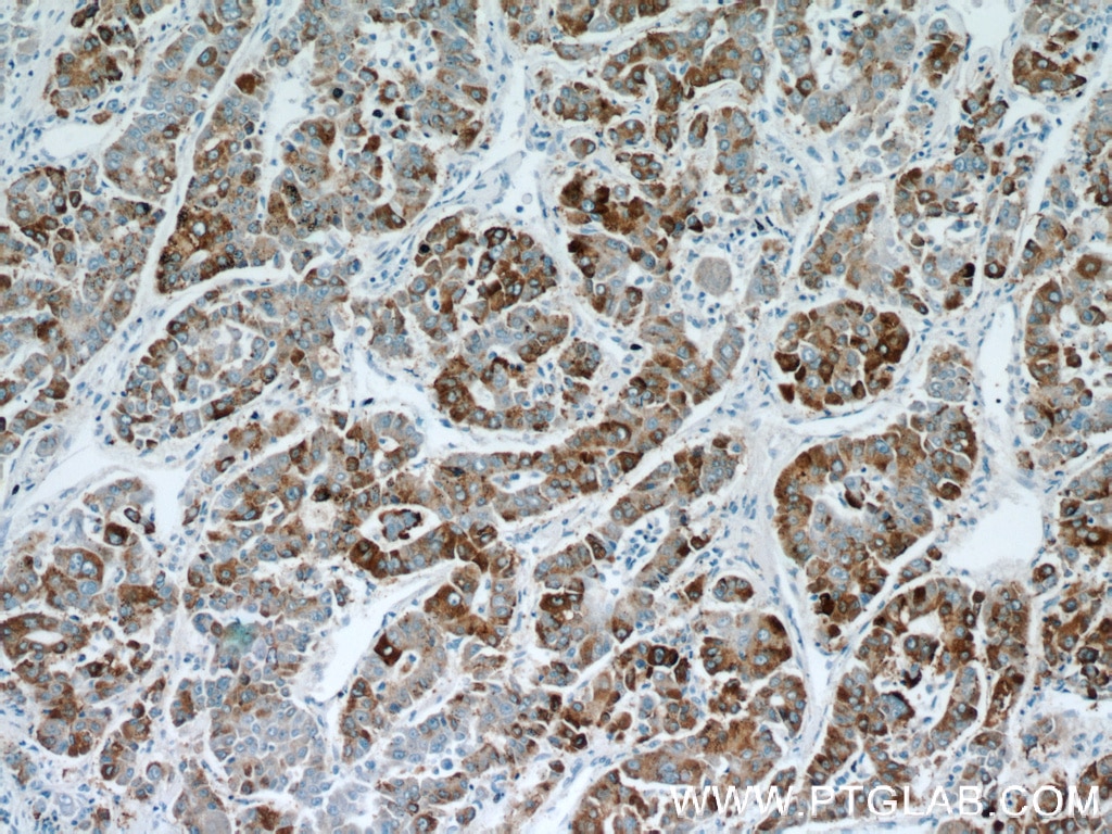 Immunohistochemistry (IHC) staining of human liver cancer tissue using B3GALT6 Polyclonal antibody (55049-1-AP)