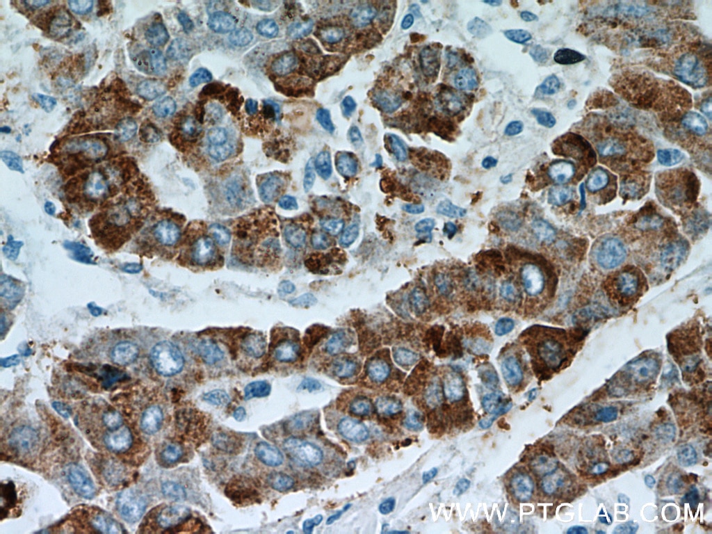 Immunohistochemistry (IHC) staining of human liver cancer tissue using B3GALT6 Polyclonal antibody (55049-1-AP)