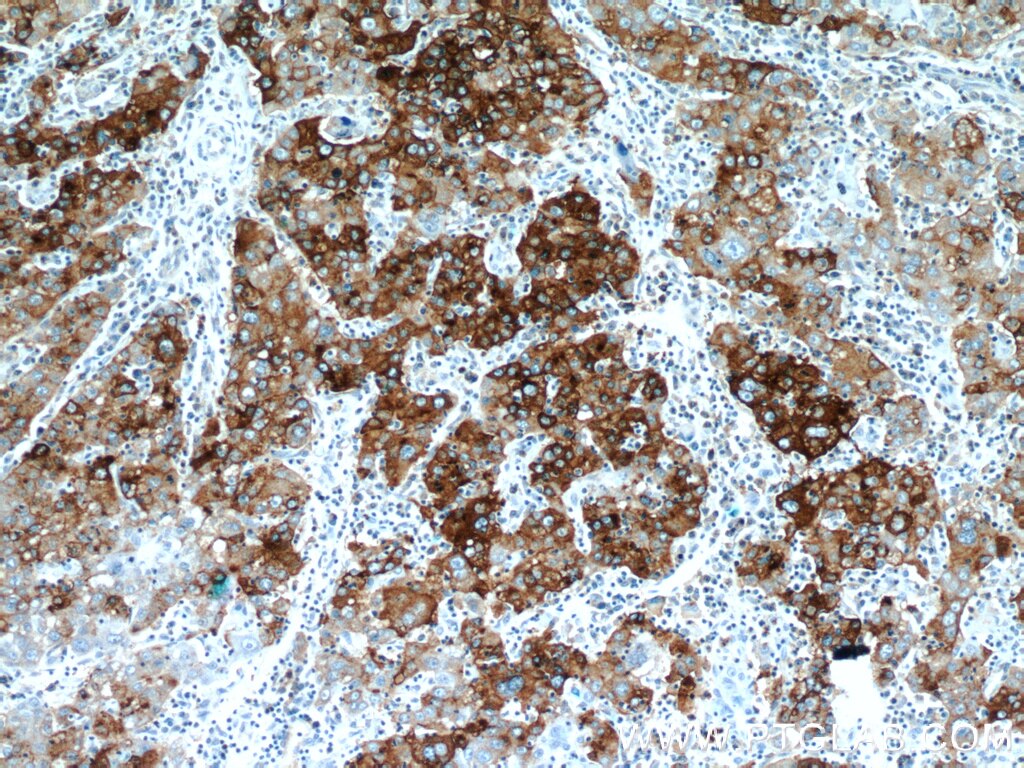 Immunohistochemistry (IHC) staining of human liver cancer tissue using B3GALT6 Polyclonal antibody (55049-1-AP)