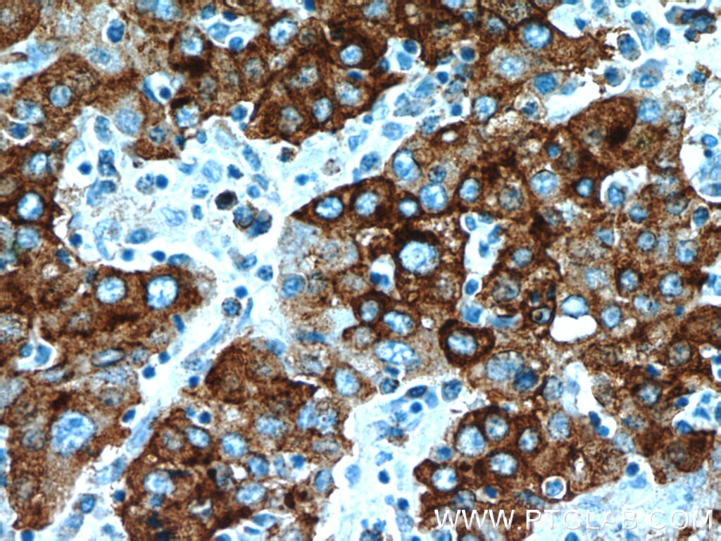 Immunohistochemistry (IHC) staining of human liver cancer tissue using B3GALT6 Polyclonal antibody (55049-1-AP)