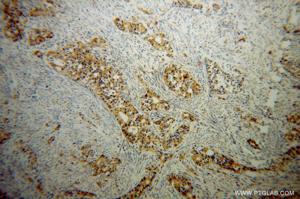 Immunohistochemistry (IHC) staining of human endometrial cancer tissue using B3GALTL Polyclonal antibody (14601-1-AP)