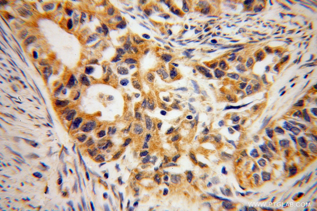 Immunohistochemistry (IHC) staining of human endometrial cancer tissue using B3GALTL Polyclonal antibody (14601-1-AP)