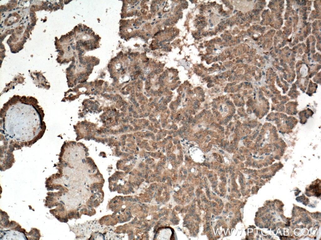 Immunohistochemistry (IHC) staining of human thyroid cancer tissue using CD57 Polyclonal antibody (19401-1-AP)