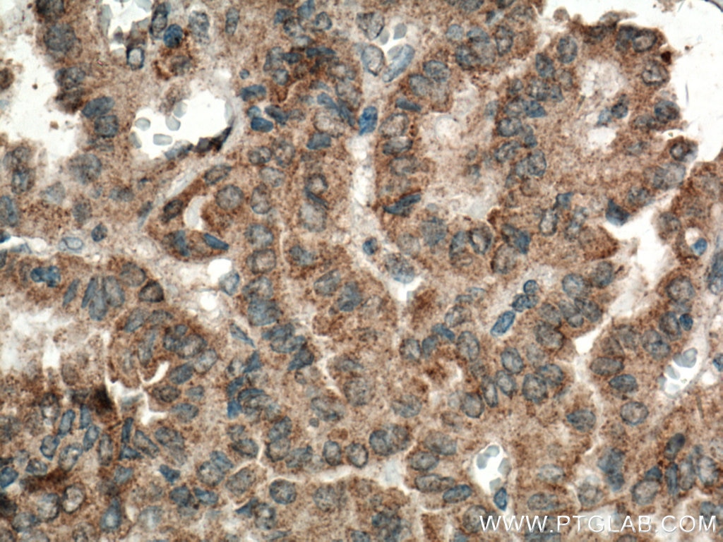 Immunohistochemistry (IHC) staining of human thyroid cancer tissue using CD57 Polyclonal antibody (19401-1-AP)
