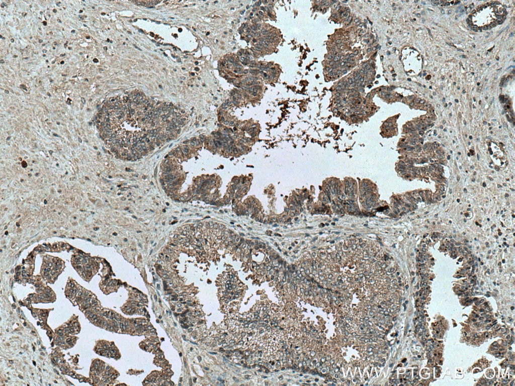 Immunohistochemistry (IHC) staining of human prostate cancer tissue using CD57 Polyclonal antibody (19401-1-AP)