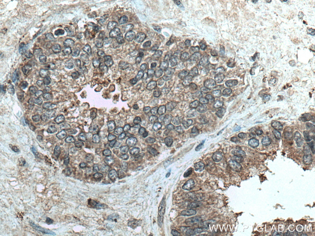 Immunohistochemistry (IHC) staining of human prostate cancer tissue using CD57 Polyclonal antibody (19401-1-AP)