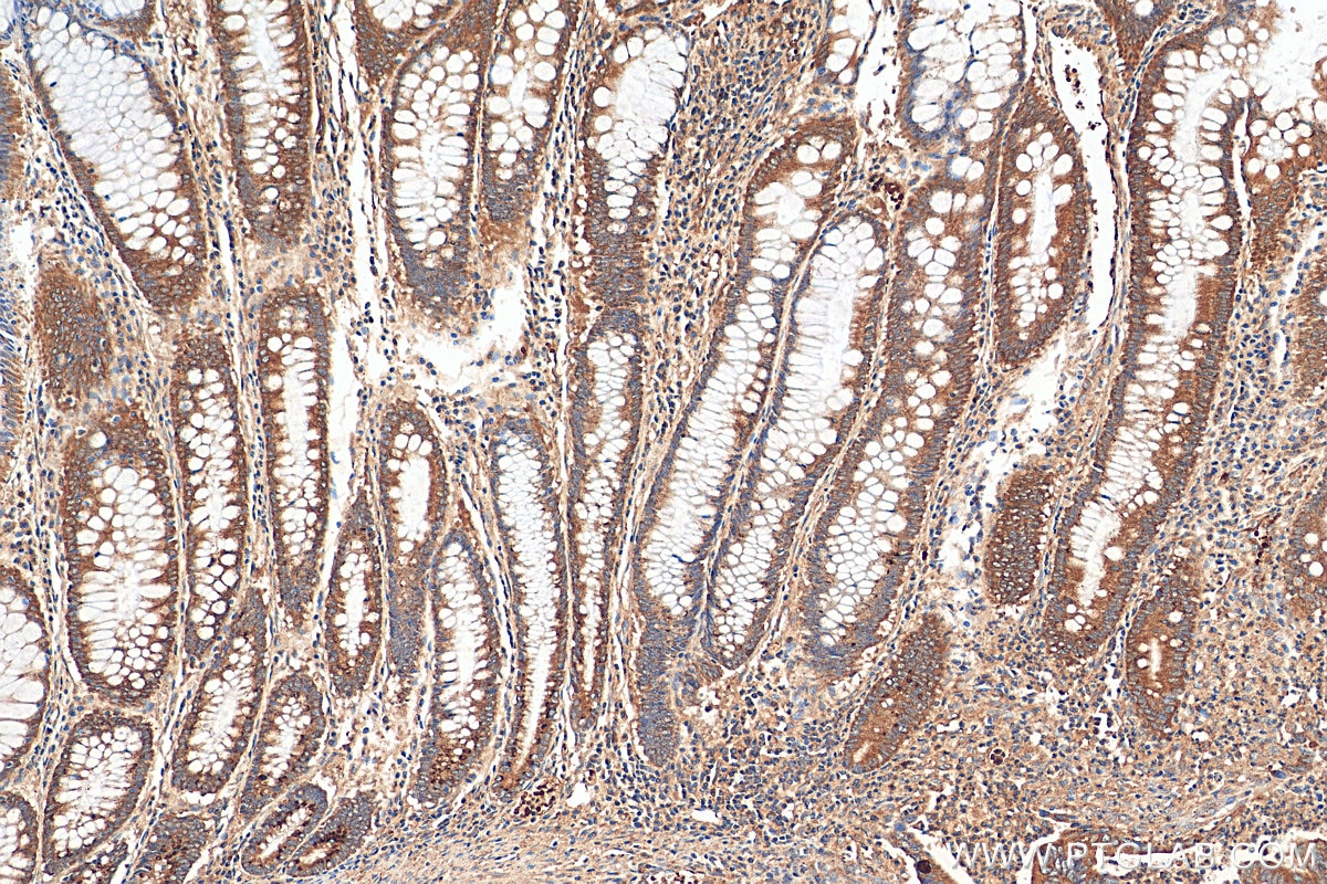 Immunohistochemistry (IHC) staining of human colon cancer tissue using B3GNT6 Polyclonal antibody (21291-1-AP)