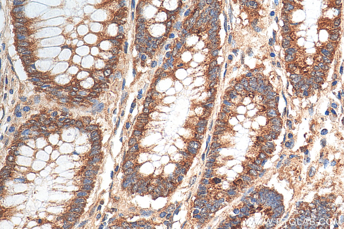 Immunohistochemistry (IHC) staining of human colon cancer tissue using B3GNT6 Polyclonal antibody (21291-1-AP)