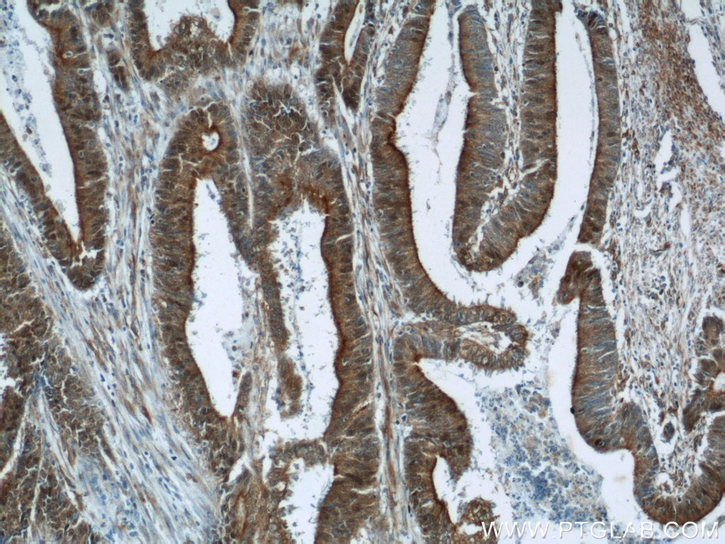 Immunohistochemistry (IHC) staining of human colon cancer tissue using B3GNT7 Polyclonal antibody (22879-1-AP)