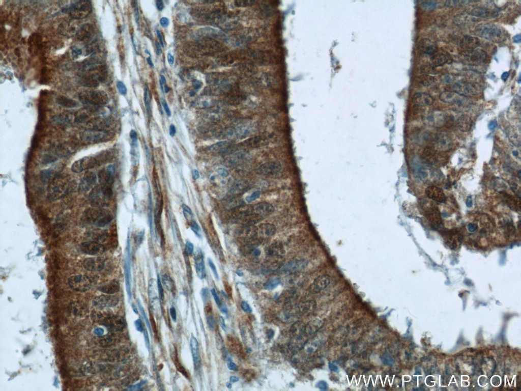 Immunohistochemistry (IHC) staining of human colon cancer tissue using B3GNT7 Polyclonal antibody (22879-1-AP)
