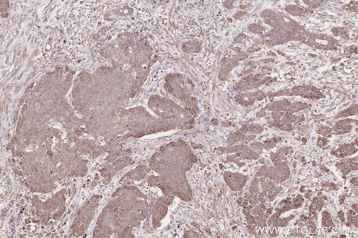 Immunohistochemistry (IHC) staining of human stomach cancer tissue using B3GNT7 Polyclonal antibody (22879-1-AP)