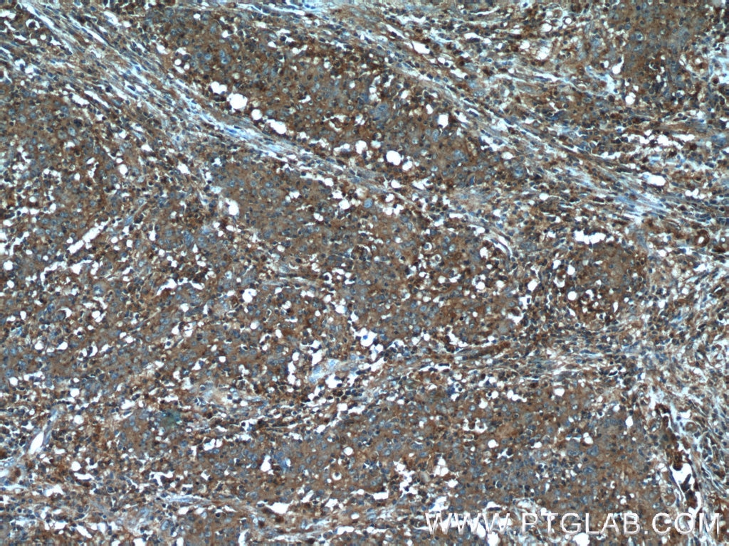 Immunohistochemistry (IHC) staining of human colon cancer tissue using B4GALNT2 Polyclonal antibody (24024-1-AP)