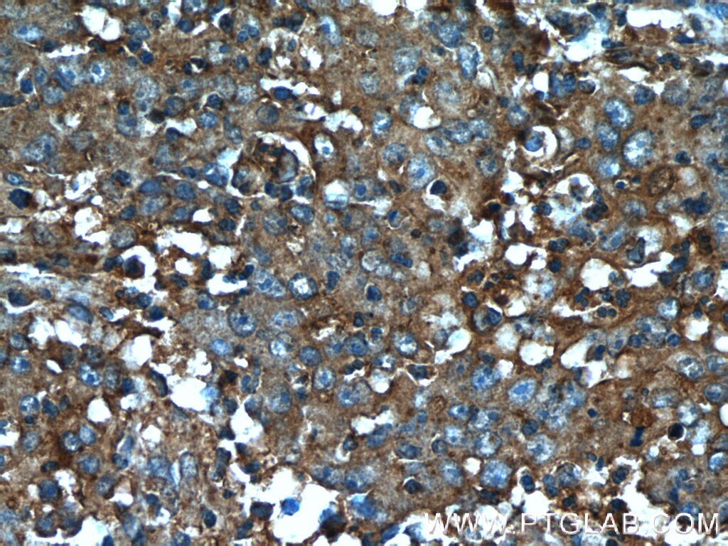 Immunohistochemistry (IHC) staining of human colon cancer tissue using B4GALNT2 Polyclonal antibody (24024-1-AP)