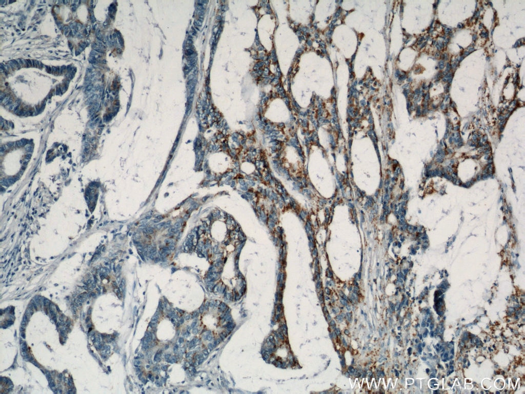 Immunohistochemistry (IHC) staining of human colon cancer tissue using B4GALT2 Polyclonal antibody (20330-1-AP)