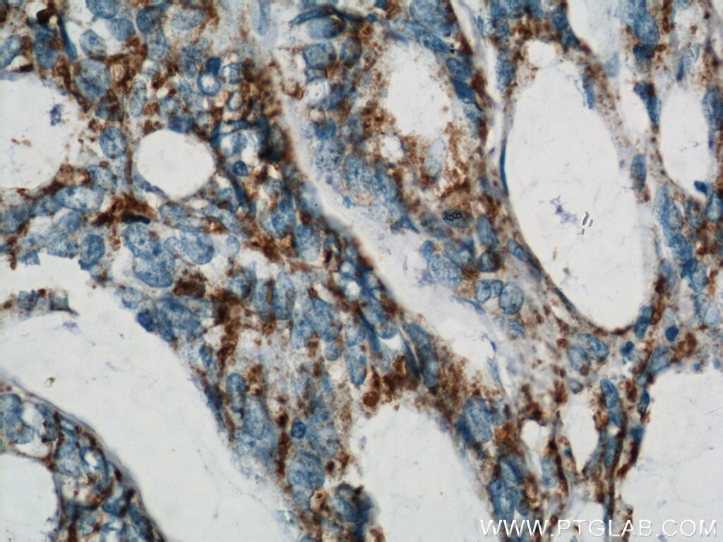 Immunohistochemistry (IHC) staining of human colon cancer tissue using B4GALT2 Polyclonal antibody (20330-1-AP)