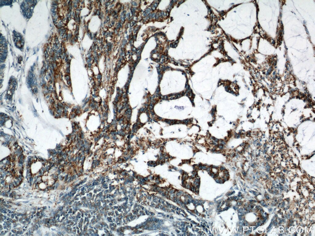 Immunohistochemistry (IHC) staining of human colon cancer tissue using B4GALT2 Polyclonal antibody (20330-1-AP)