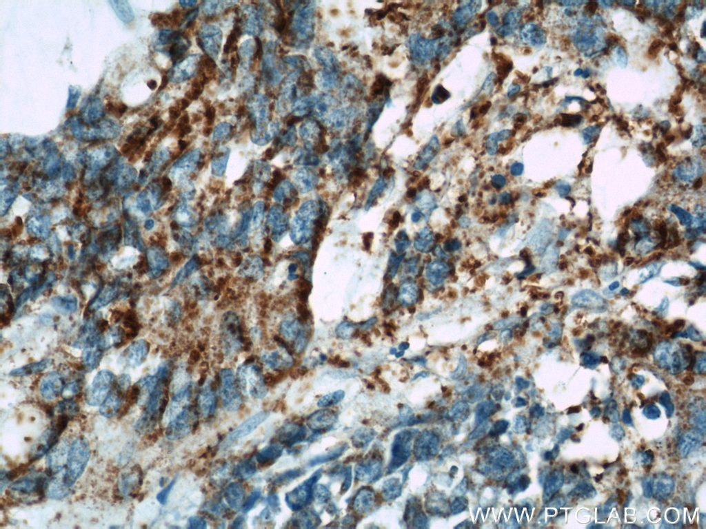 Immunohistochemistry (IHC) staining of human colon cancer tissue using B4GALT2 Polyclonal antibody (20330-1-AP)