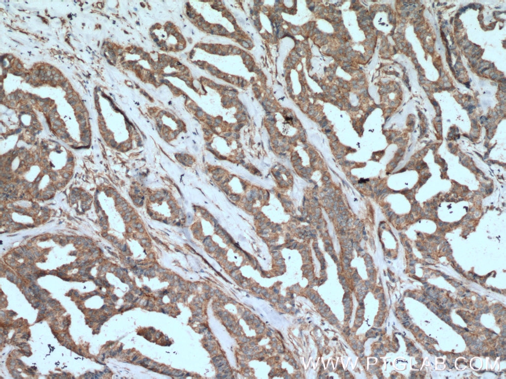 Immunohistochemistry (IHC) staining of human breast cancer tissue using B4GALT3 Polyclonal antibody (11041-1-AP)