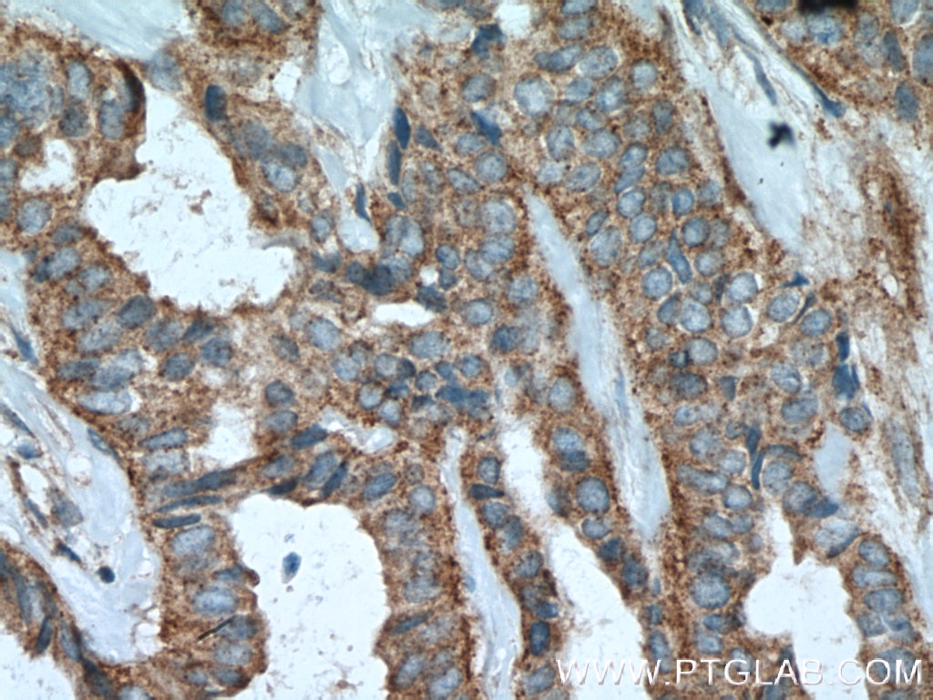 IHC staining of human breast cancer using 11041-1-AP