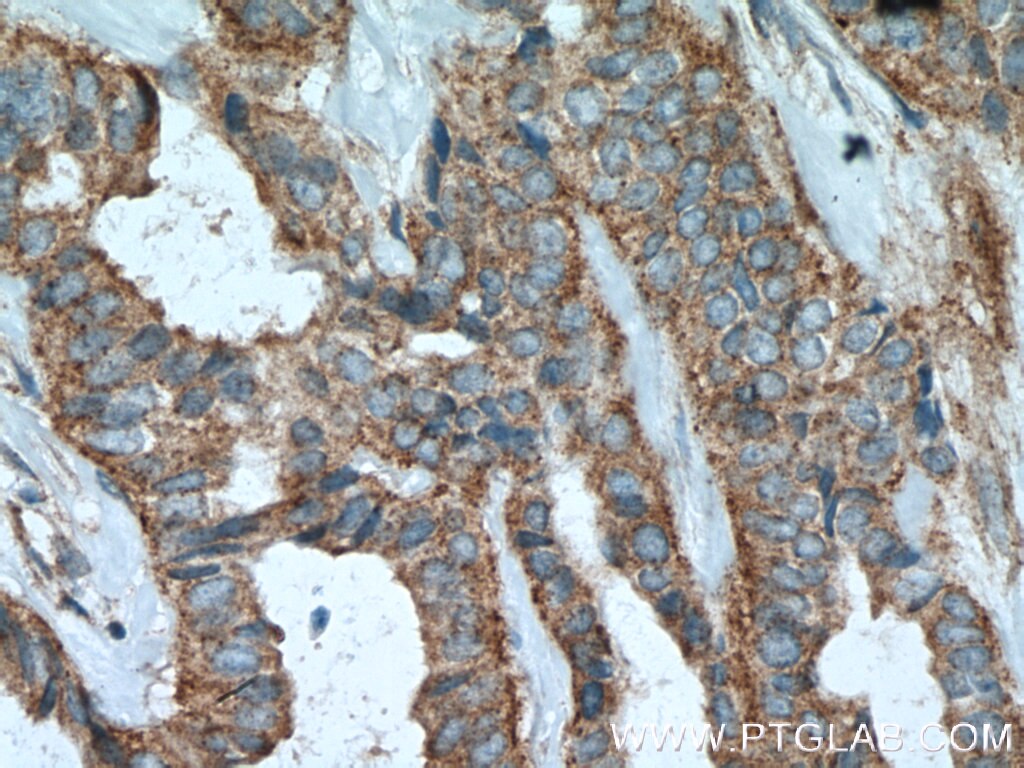 Immunohistochemistry (IHC) staining of human breast cancer tissue using B4GALT3 Polyclonal antibody (11041-1-AP)