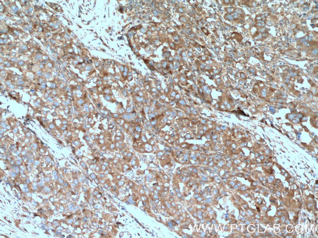 Immunohistochemistry (IHC) staining of human liver cancer tissue using B4GALT3 Polyclonal antibody (11041-1-AP)