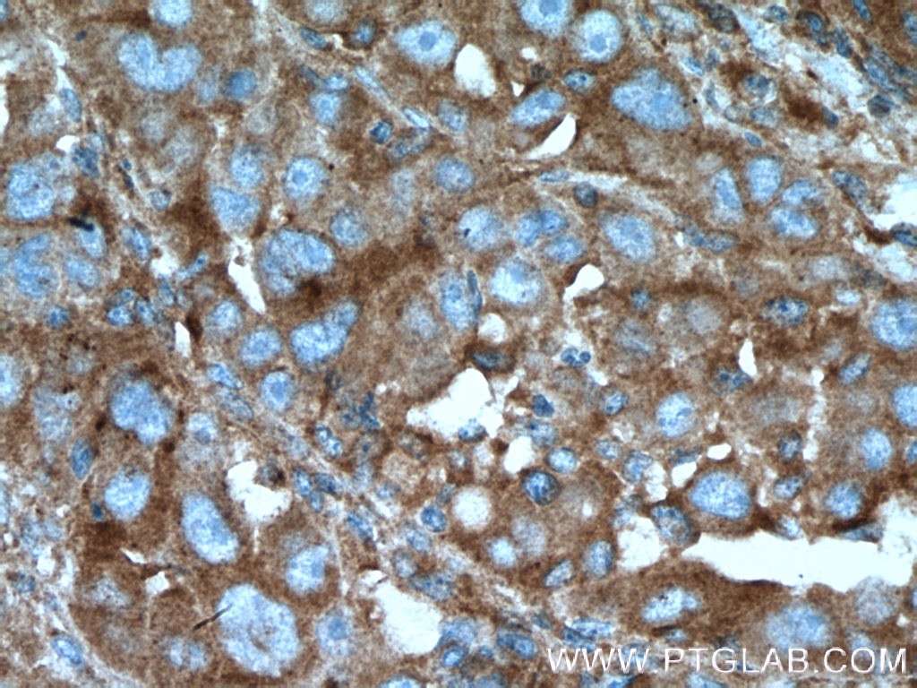 Immunohistochemistry (IHC) staining of human liver cancer tissue using B4GALT3 Polyclonal antibody (11041-1-AP)