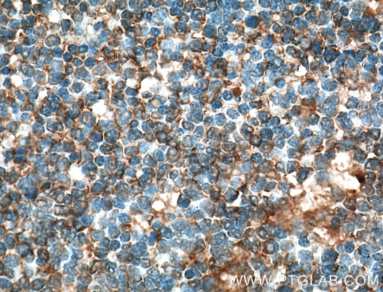 IHC staining of human tonsillitis using 66406-1-Ig