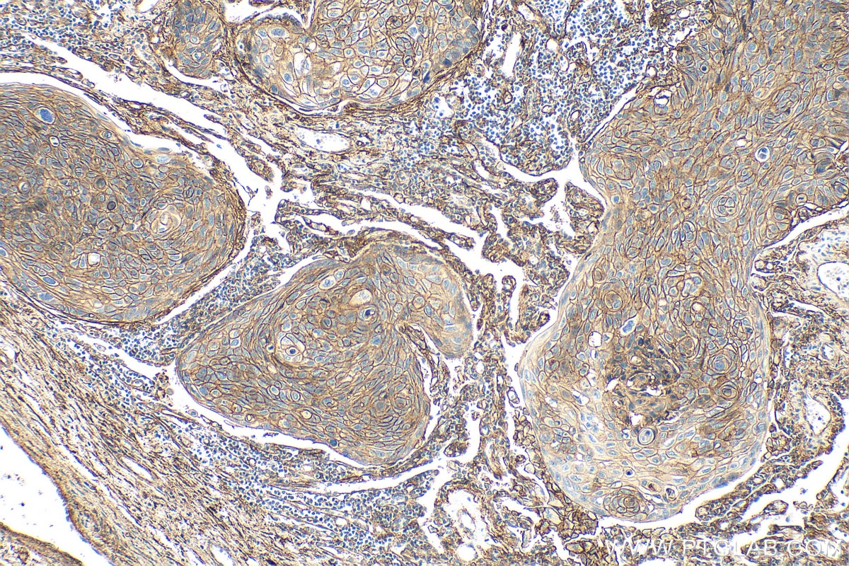 Immunohistochemistry (IHC) staining of human lung cancer tissue using B7-H3/CD276 Polyclonal antibody (30052-1-AP)