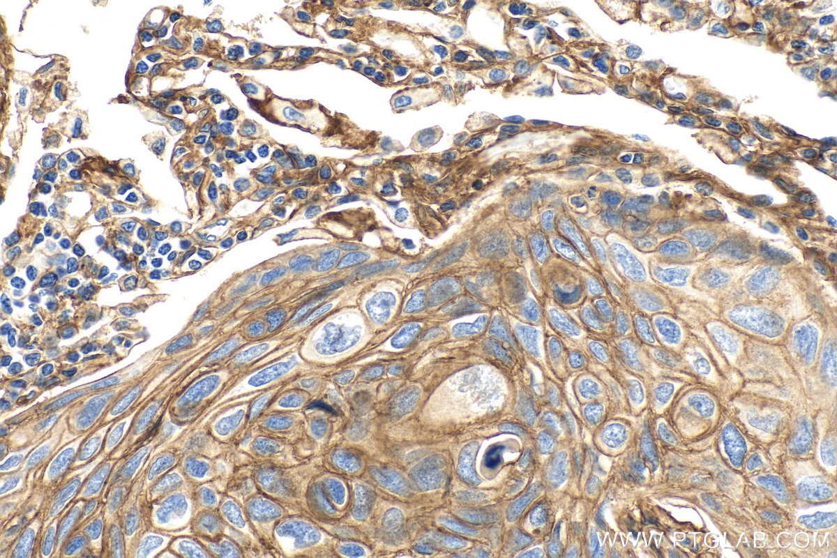 Immunohistochemistry (IHC) staining of human lung cancer tissue using B7-H3/CD276 Polyclonal antibody (30052-1-AP)