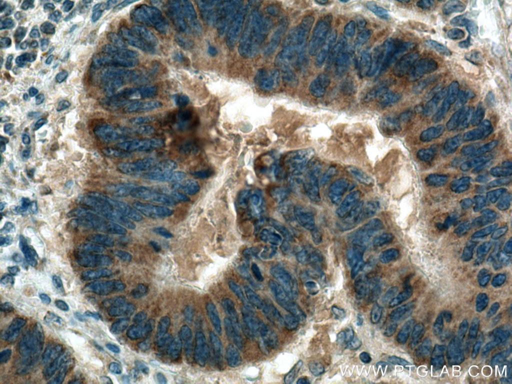 Immunohistochemistry (IHC) staining of human colon cancer tissue using B9D2 Polyclonal antibody (22058-1-AP)