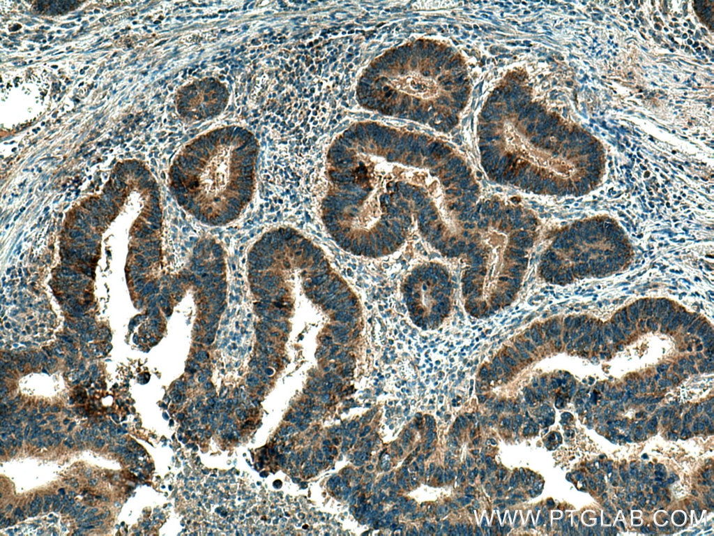Immunohistochemistry (IHC) staining of human colon cancer tissue using B9D2 Polyclonal antibody (22058-1-AP)