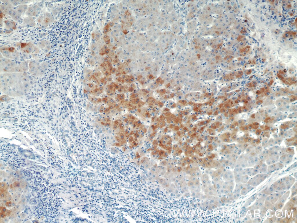 Immunohistochemistry (IHC) staining of human hepatocirrhosis tissue using BAAT Polyclonal antibody (15990-1-AP)