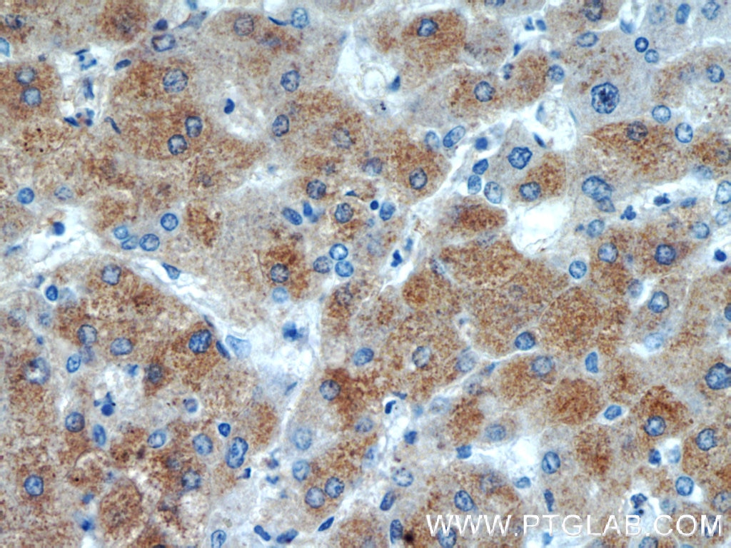Immunohistochemistry (IHC) staining of human hepatocirrhosis tissue using BAAT Polyclonal antibody (15990-1-AP)