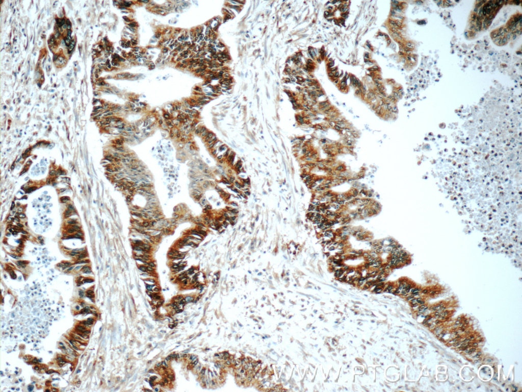 Immunohistochemistry (IHC) staining of human pancreas cancer tissue using BACE1 Polyclonal antibody (12807-1-AP)