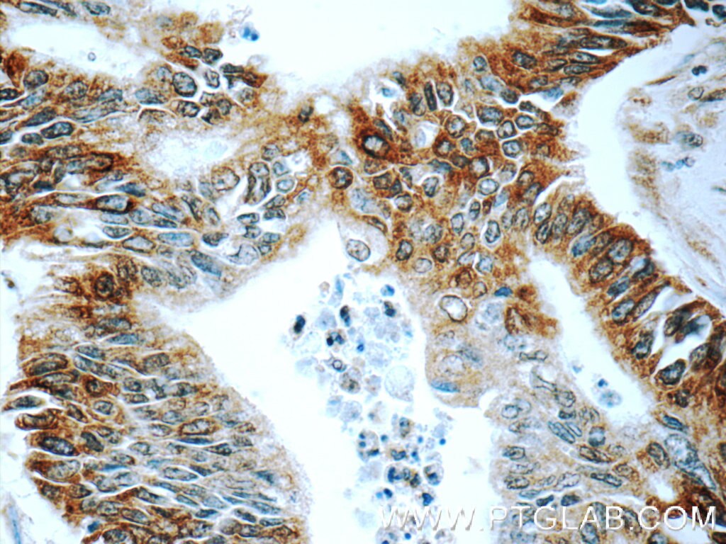 IHC staining of human pancreas cancer using 12807-1-AP