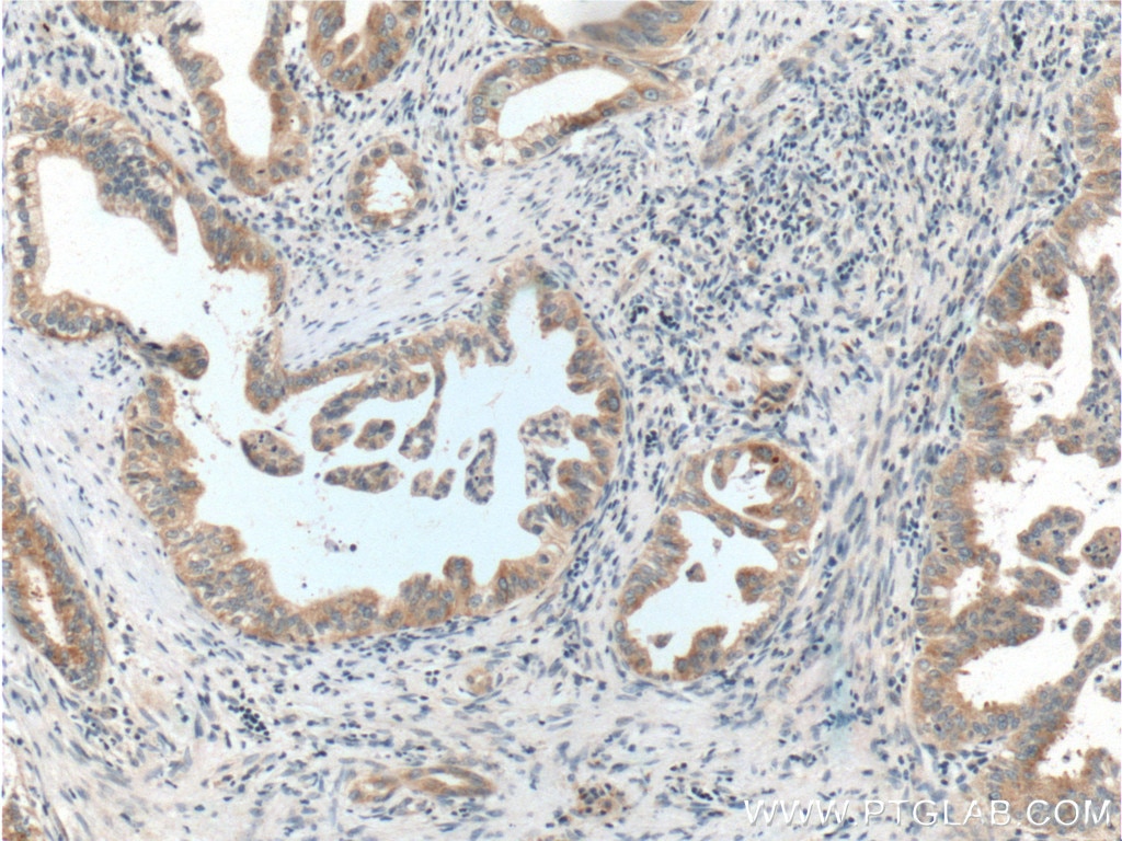 IHC staining of human pancreas cancer using 12807-1-AP