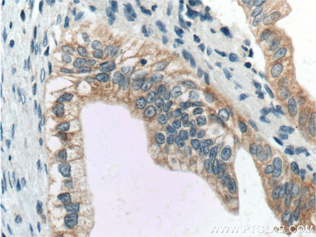 Immunohistochemistry (IHC) staining of human pancreas cancer tissue using BACE1 Polyclonal antibody (12807-1-AP)